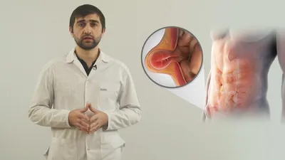 Паховые грыжи | FDMClinic.com