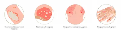 Псориаз ногтей — Derma.ua