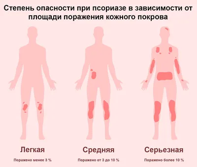 Как выглядит псориаз (фото 1-9). Симптомы псориаза на голове, руках и  ногах. Как начинается псориаз - YouTube