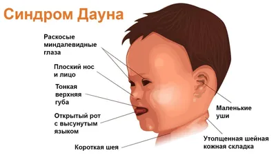 Синдром Дауна: риск, причины, признаки при беременности