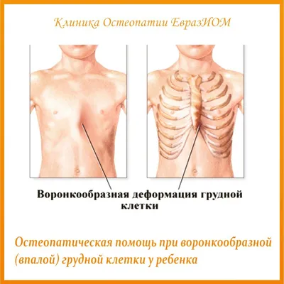 Деформация грудной клетки - причины появления, при каких заболеваниях  возникает, диагностика и способы лечения