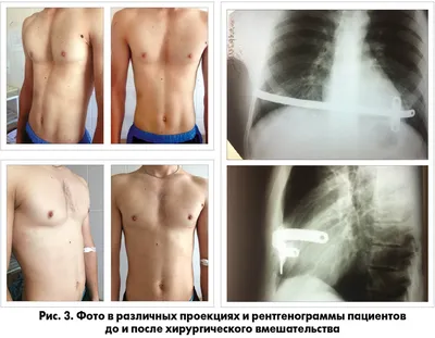 Килевидная грудная клетка – симптомы, причины, диагностика и лечение  заболевания | «Будь Здоров»