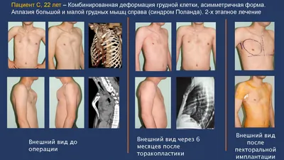 Безоперационная коррекция воронкообразной деформации грудной клетки в  Краснодаре при помощи вакуумного колокола | Пластический хирург Маркушин  Виктор Александрович