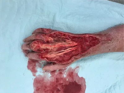 CRUSH INJURY FOOT, LOWER LIMB INJURIES AND LIMB SALVAGE: DEGLOVING INJURY  LEG AND KNEE - GROSSLY DISPLACED FRACTURE TIBIA EX - CROSS LEG FLAP AND  SKIN GRAFTING