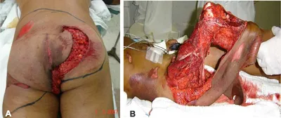 A Case Report of a Complete Penile and Scrotum Skin Degloving Injury. -  Abstract - Europe PMC