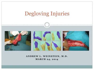 Trauma: Multiple finger degloving treated with medial cross arm flap and  temporary syndactyly