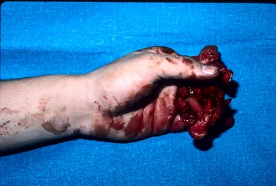 Case 55 Degloving Injury | Plastic Surgery Key