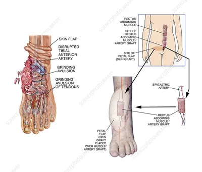 Figure 1 from Degloving injuries of trunk and limbs: comparison of outcomes  of early versus delayed assessment by the plastic surgery team. | Semantic  Scholar