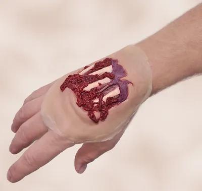 ❗️WARNING VERY GRAPHIC ❗️- Full degloving of the extremity. : r/medizzy