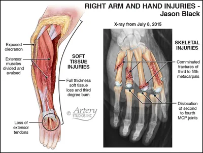 Cureus | Management of Heel Pad Degloving Injury After Severe Foot Crush  Injury: A Case Report Study | Article