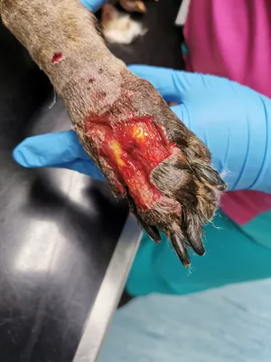 Trauma: Multiple finger degloving treated with medial cross arm flap and  temporary syndactyly