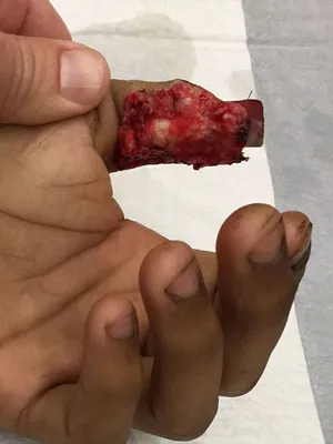 Case 5, patient with bilateral hand crush/degloving injury, a, b defect...  | Download Scientific Diagram