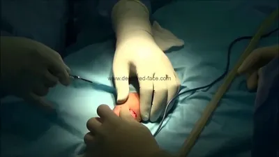 Degloving Wound \"Bella\"