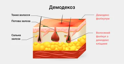 ᐈ Что такое демодекоз? ~【Лечение демодекоза в Киеве】