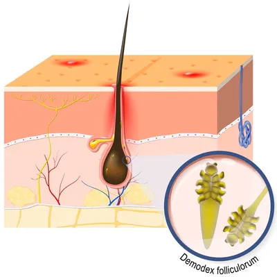 Демодекоз у человека — фото на лице у женщин, признаки, симптомы, лечение