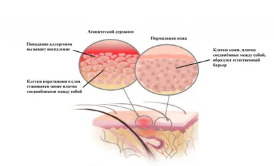 Атопический дерматит у взрослых и детей: лечение, симптомы, причины  дерматита | Клиника МедПросвет
