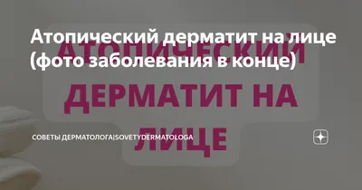 Себорейный дерматит у детей: причины, особенности лечения в 4, 6, 7, 8, 9  лет