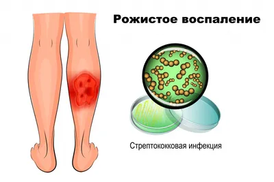 Пиодермии - причины появления, симптомы заболевания, диагностика и способы  лечения