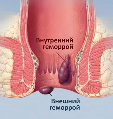 Эритразма: симптомы, причины, диагностика, лечение| АО «Медицина» (клиника  академика Ройтберга)