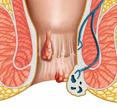 Анальный зуд - причины появления, при каких заболеваниях возникает,  диагностика и способы лечения
