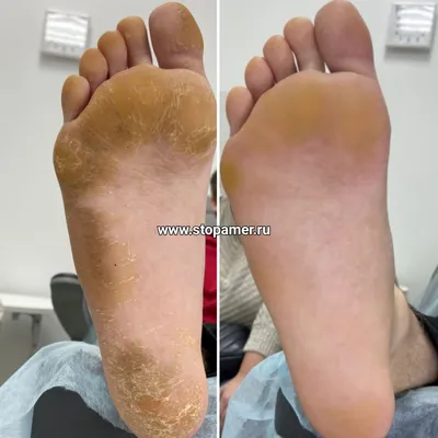 Онихомикоз, Дерматомикоз-... - podolog_pedicure_zr | Facebook