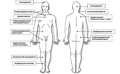 Лечение и диагностика полимиозита и воспалительных миопатий