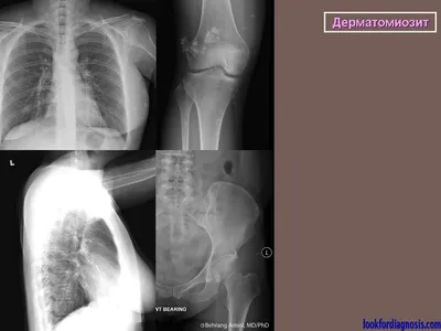 Дерматомиозит. + | Портал радиологов