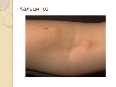 Пойкилодермия кожи: лечение - Premium Aesthetics