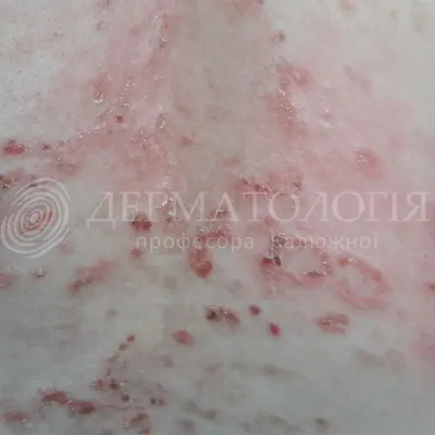 DermatoloQ Dr. Nadir Ahmadli - Пепельный Дерматоз (Стойкая Дисхромическая  Эритема) | Facebook