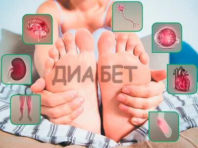 Лечение синдрома диабетической стопы в Одессе | Ocsarat Medical