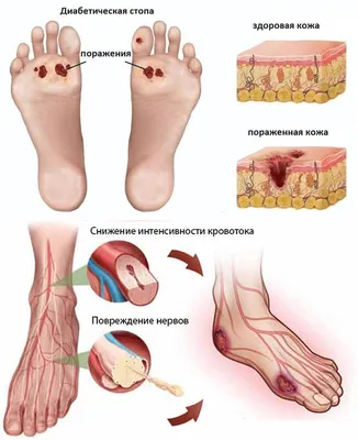 Ишемическая Диабетическая Стопа Лечение в Киеве