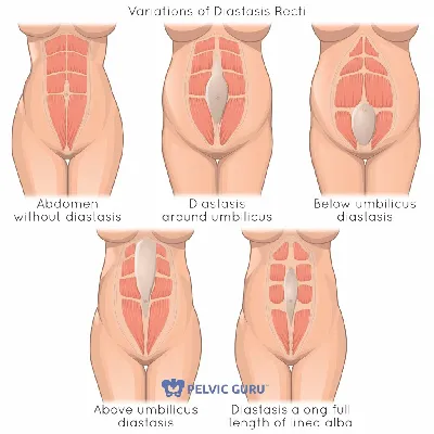 Диастаз прямых мышц живота и дисфункция тазового дна - KinesioPro