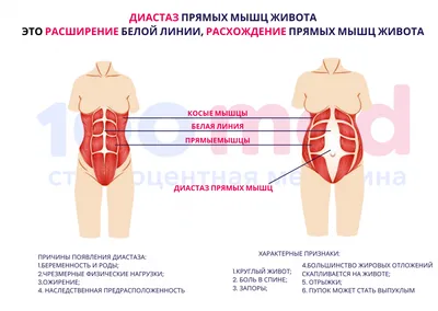 Диастаз прямых мышц живота - симптомы, причины, лечение