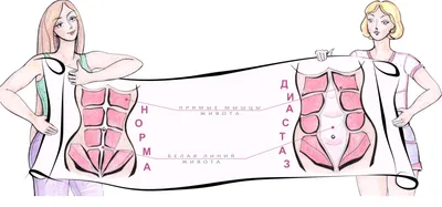 Абдоминопластика, ушивание диастаза прямых мышц живота, операция — в VIP  Clinic, цены в Москве. Операция по устранению диастаза, пластика белой  линии живота, передней стенки живота у мужчин, у женщин после родов.  Стоимость