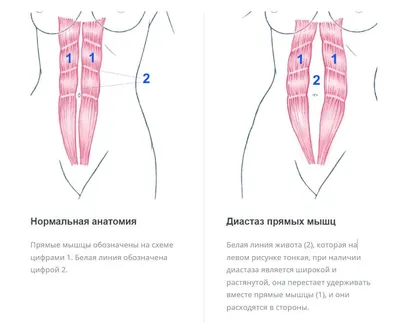 🏥 ✓Диастаз прямых мышц живота ⋆ 2023