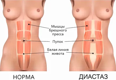 🏥 ✓Диастаз прямых мышц живота ⋆ 2023