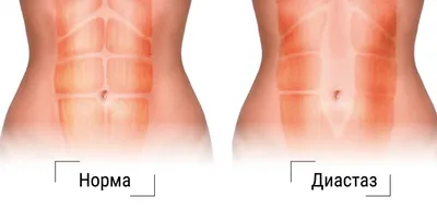 Абдоминопластика, ушивание диастаза прямых мышц живота, операция — в VIP  Clinic, цены в Москве. Операция по устранению диастаза, пластика белой  линии живота, передней стенки живота у мужчин, у женщин после родов.  Стоимость