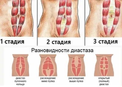 Что такое диастаз | Как убрать диастаз