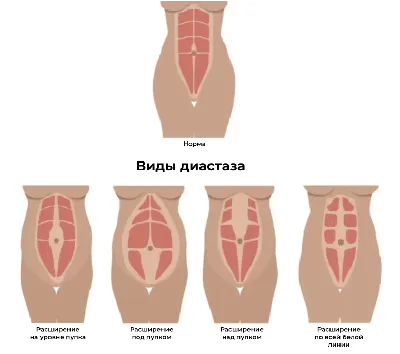 Как избавиться от живота после кесарева сечения