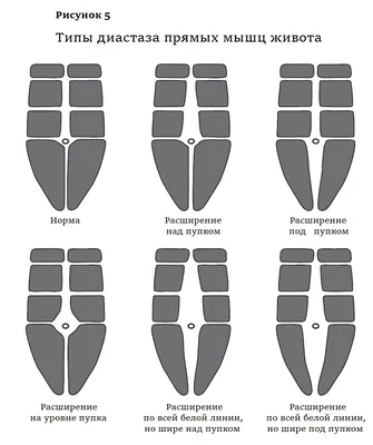 Лечите ли вы диастаз прямых мышц живота? - Евразийский центр бариатрии