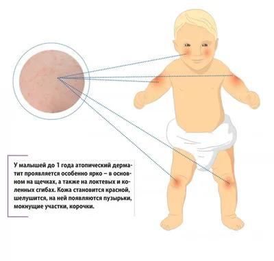 Диатез у детей: о красных щеках, влажном климате и трудностях перевода |  Woman.ru | Дзен