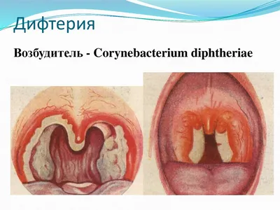 Дифтерия. Легче предупредить… - добрый доктор