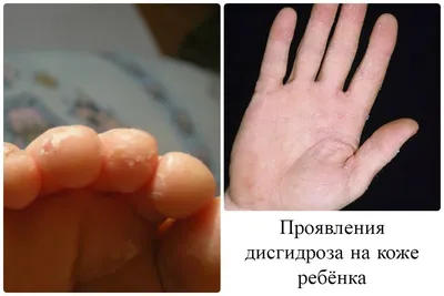 Файл:Palmar dyshidrosis peeling stage.JPG — Википедия