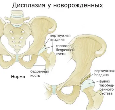 Признаки дисплазии ТБС | Дисплазия ТБС у ребенка | @Galia_Ignatieva_MD -  YouTube