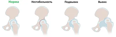 Асимметрия складок на ножках у ребёнка-это признак дисплазия тазобедренных  суставов?К - YouTube