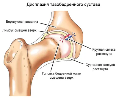 Дисплазия тазобедренных суставов