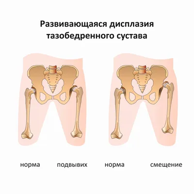 Дисплазия | остеопатия