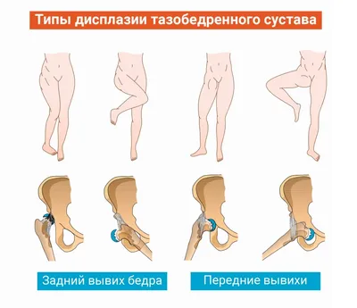 Дисплазия | остеопатия