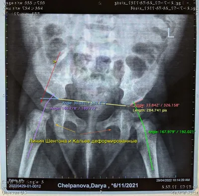 Дисплазия тазобедренного сустава | Первая Медицинская Клиника | Дзен