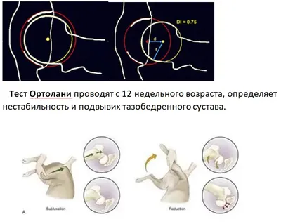 Дисплазия тазобедренного сустава | Лечение дисплазии ТБС у детей и взрослых  ᐉ Ladisten